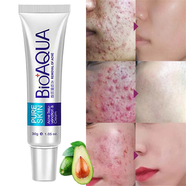 KIT ANTI ACNE BIOAQUA[PAGO CONTRA ENTREGA!]